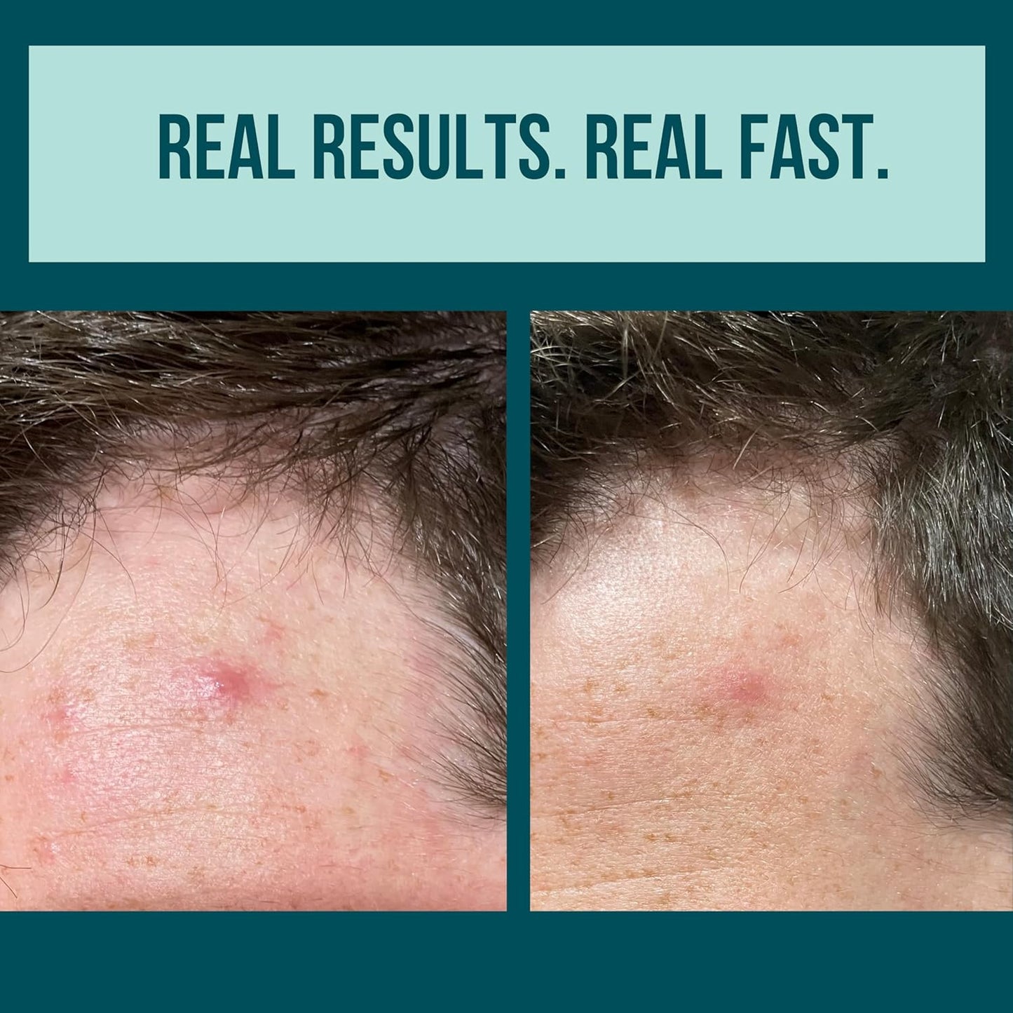 Cardon Prickly Patch – Korean Acne Spot Treatment